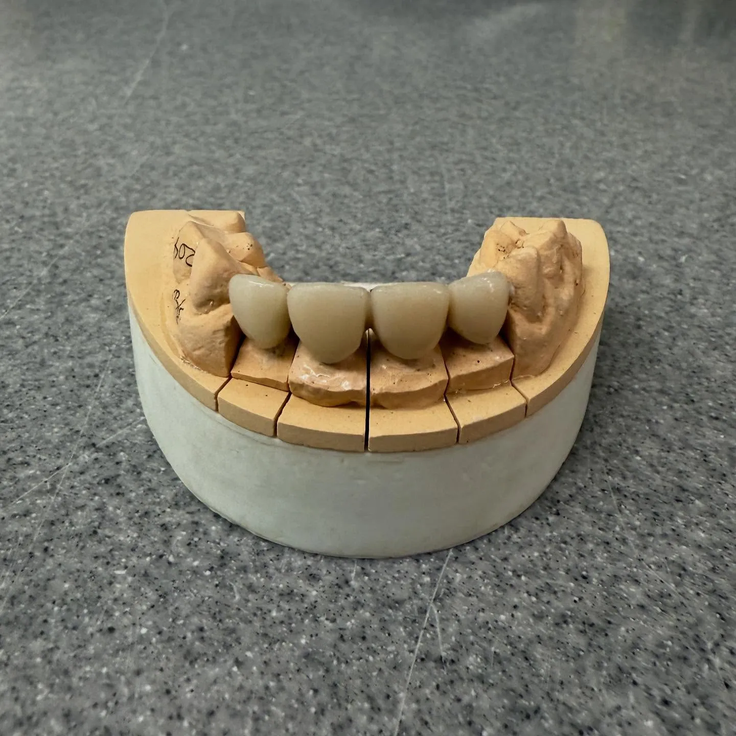 セラミックとレジン、どちらが自分に合っている?